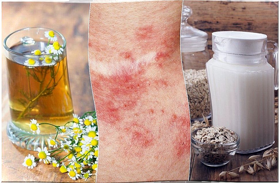 5 home remedies to treat contact dermatitis