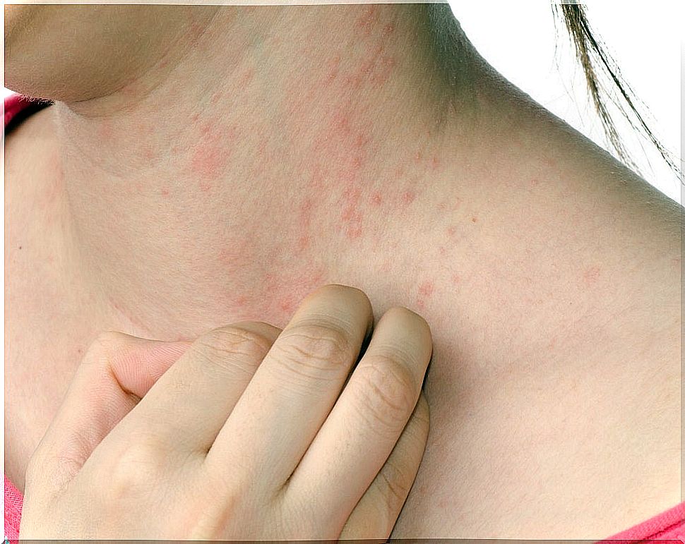 eczema skin on neck