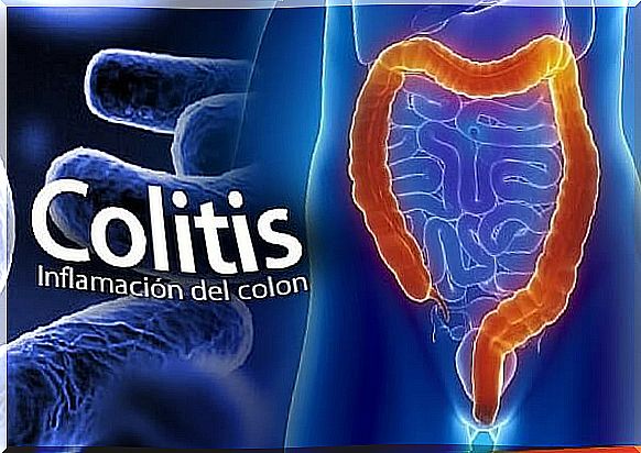 6 natural treatments to fight colitis