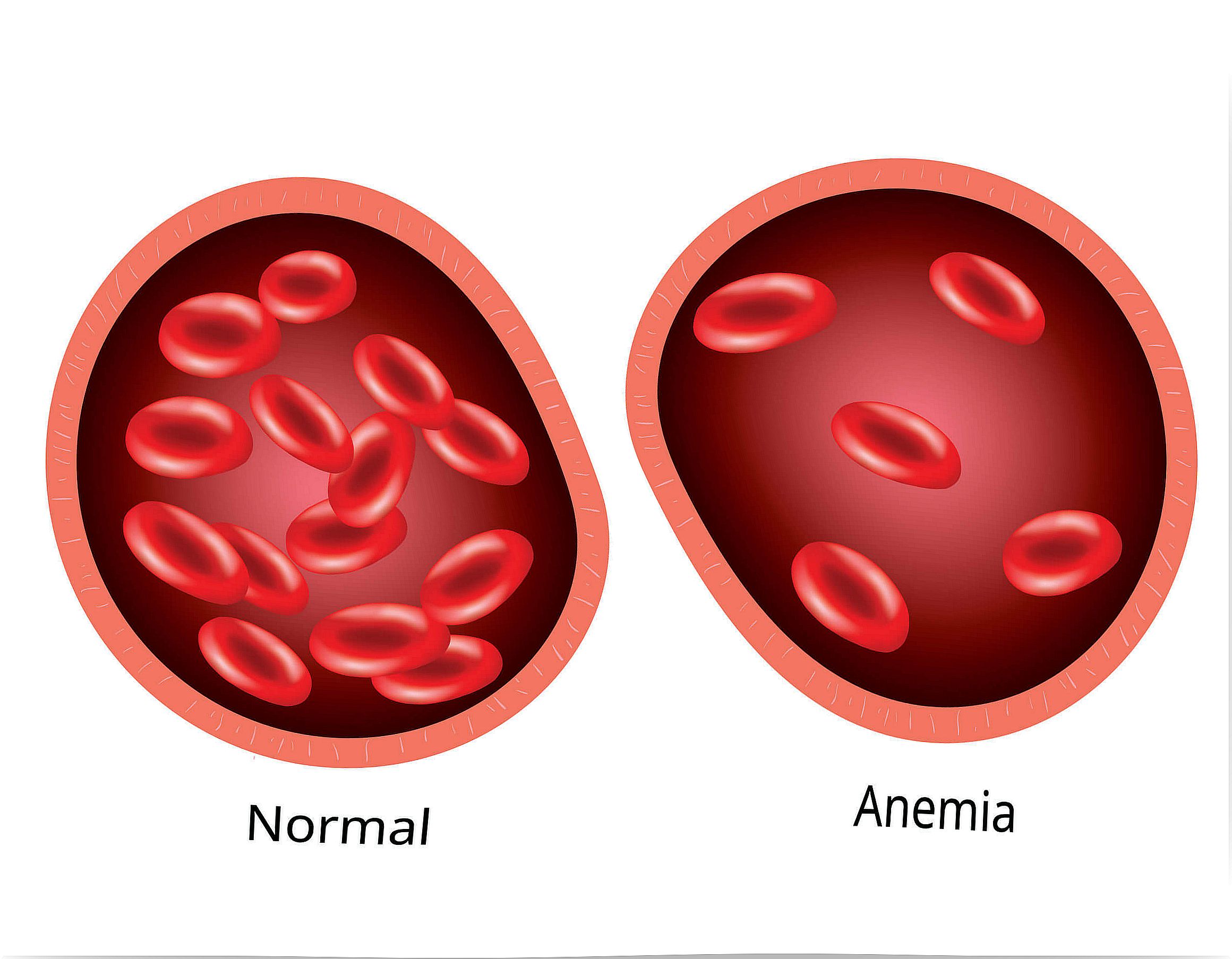 Anemia in children is due to problems with red blood cells.