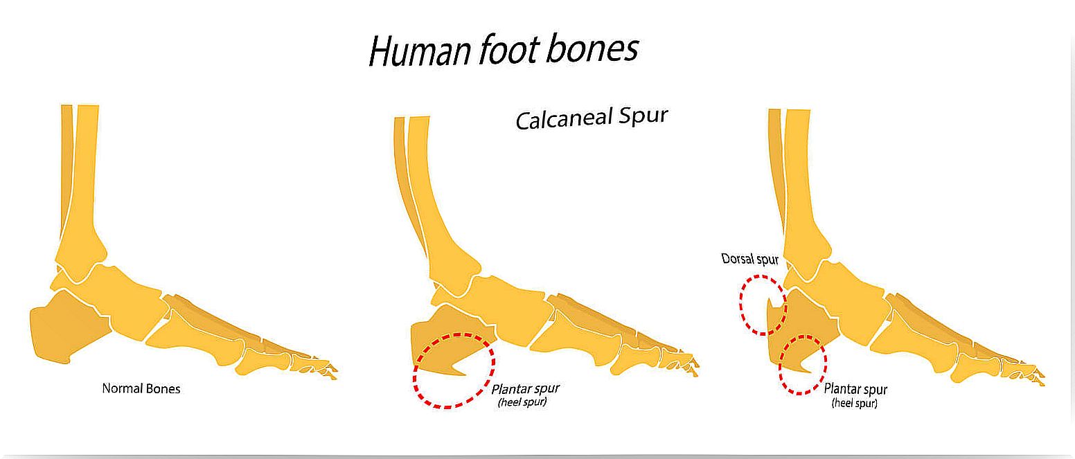 Foot bones: heel spur.