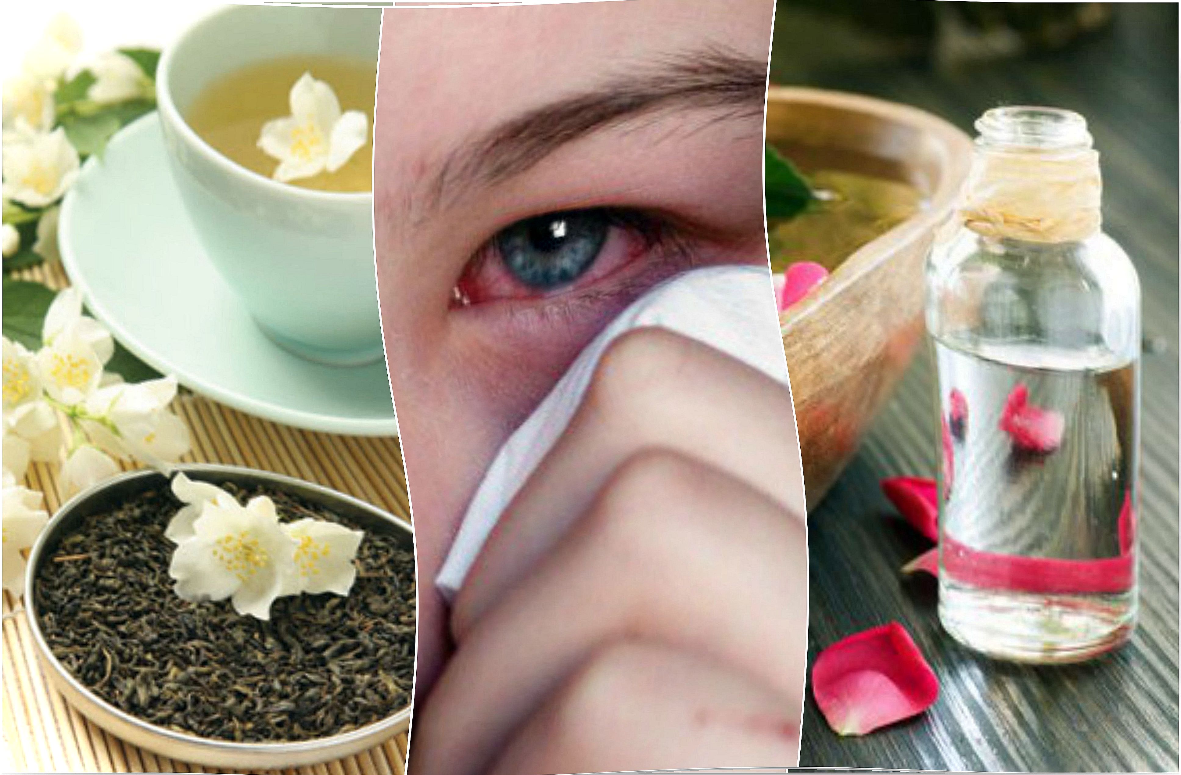 How to treat eye infections with 5 natural remedies