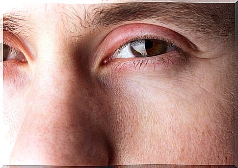 How to treat styes with natural remedies