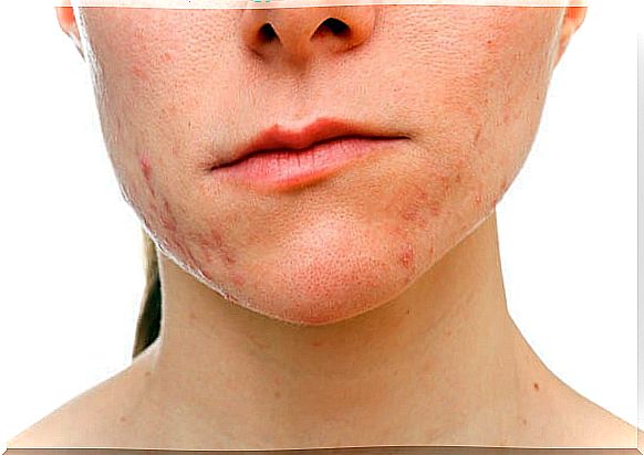 Tips to eliminate acne that appears on the chin