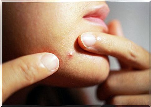 Effective and natural treatment to eliminate acne on the chin