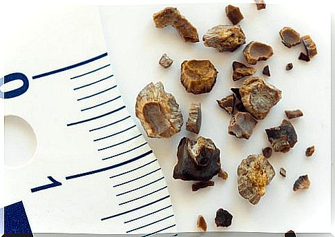 There are several types of kidney stones
