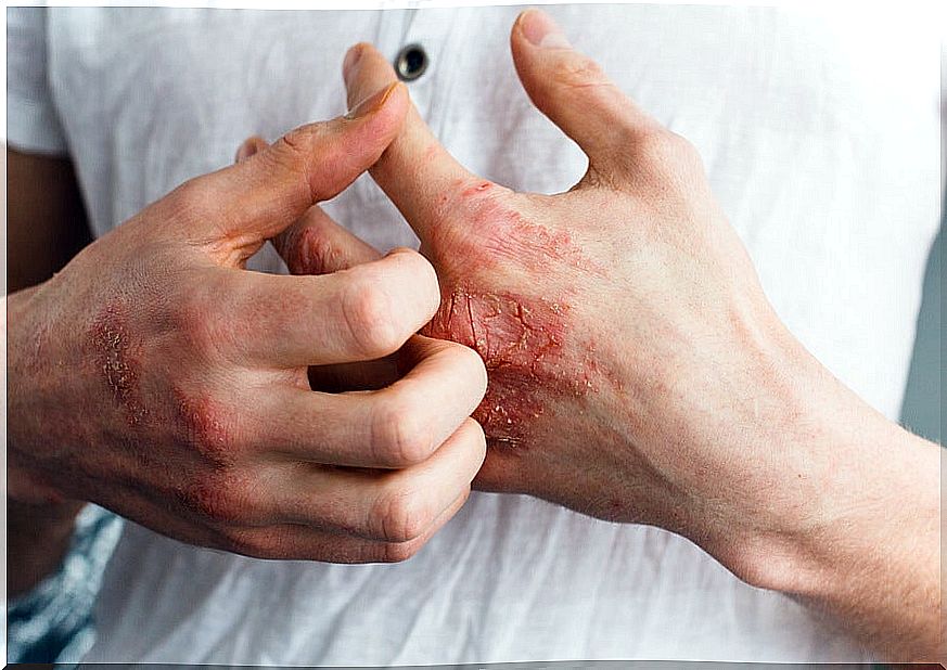 What is the atopic dermatitis?