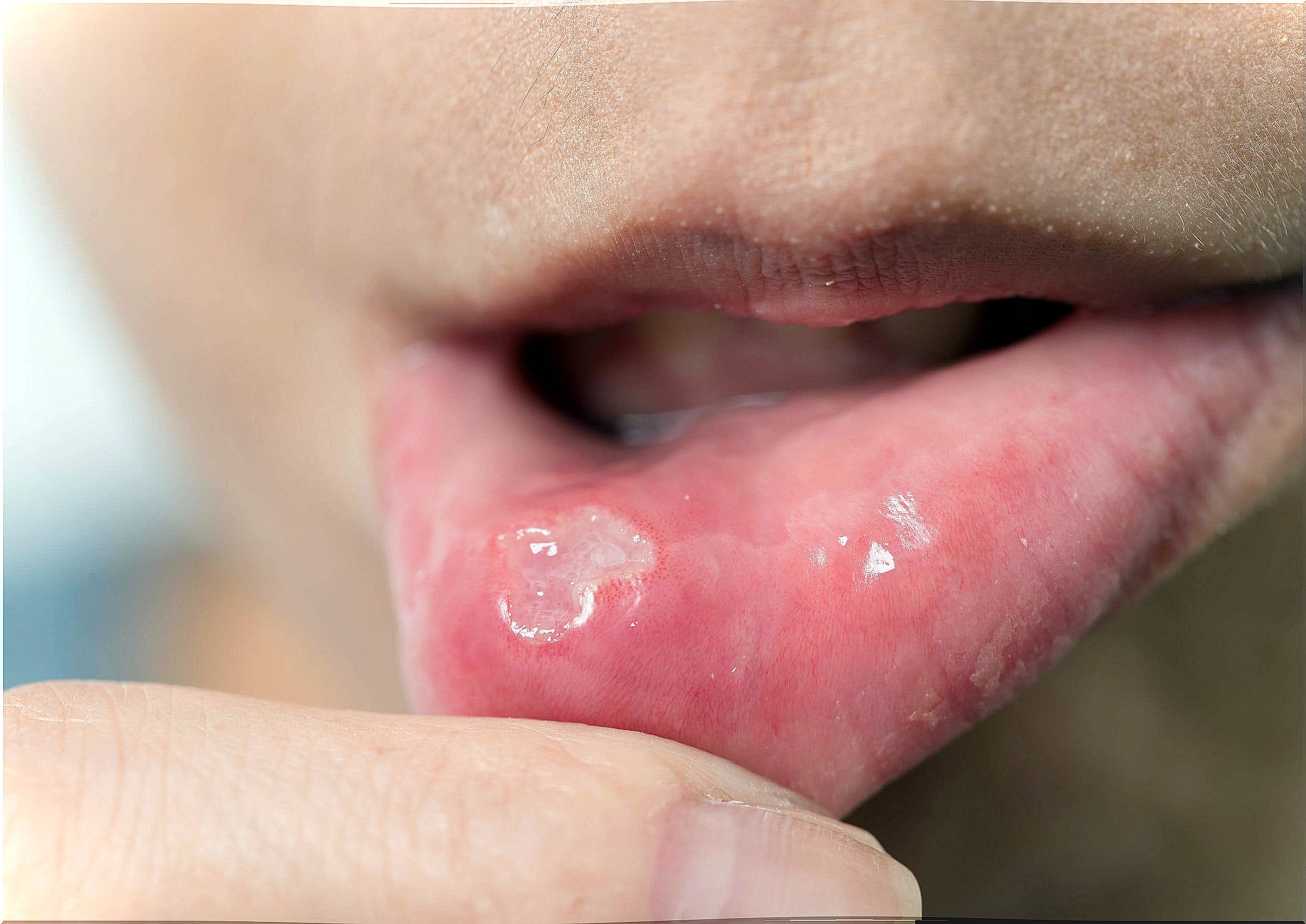 Why do mouth sores appear?